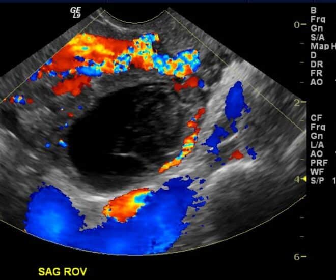 Ovarian Cysts: Types, Causes, Diagnosis, and Treatments