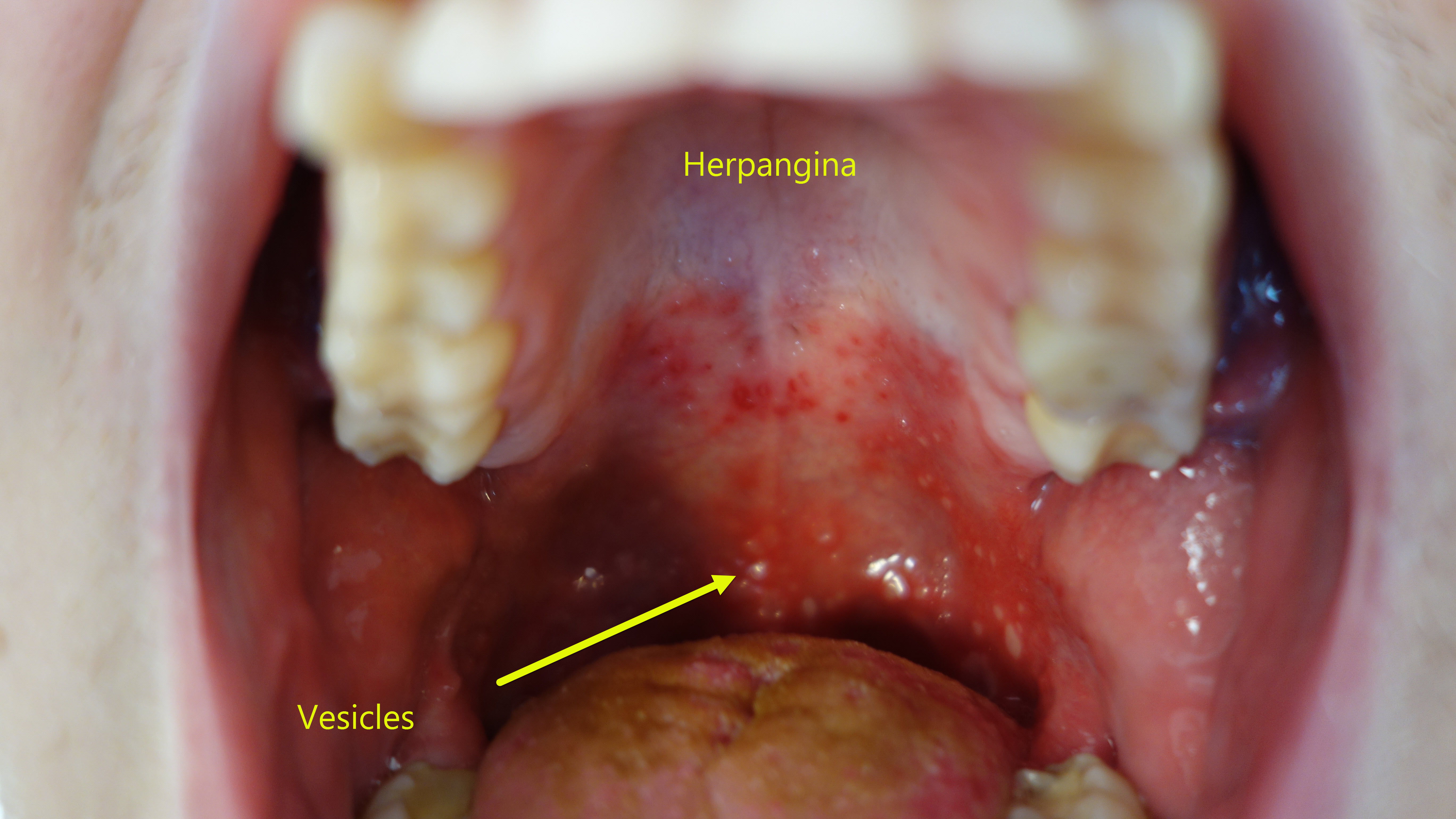 Herpangina: A Complete Guide to the Mouth Ulcer Disease (Herpangina)