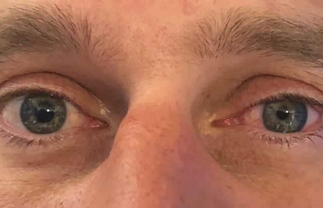 Horner’s Syndrome: A Complete Overview of the Nerve Disorder