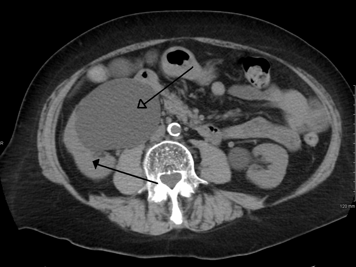 Hydronephrosis: Causes, Symptoms, Diagnosis, and Treatment (Kidney Swelling)