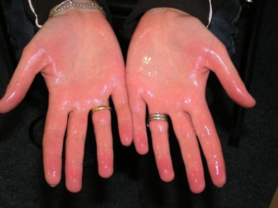 Excessive Sweating (Hyperhidrosis): Causes, Symptoms, and Treatments