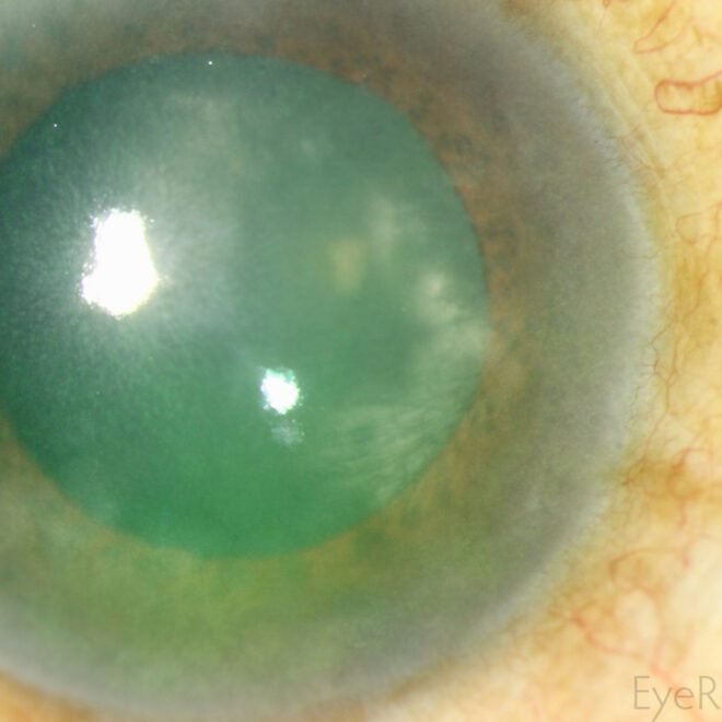 Keratitis: Causes, Symptoms, Diagnosis, and Treatment Options