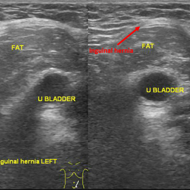 Groin Hernia: Types, Causes, Symptoms, and Treatments