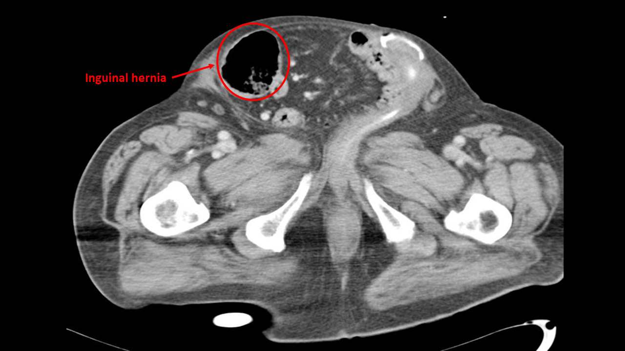 Groin Hernia: Types, Causes, Symptoms, and Treatments