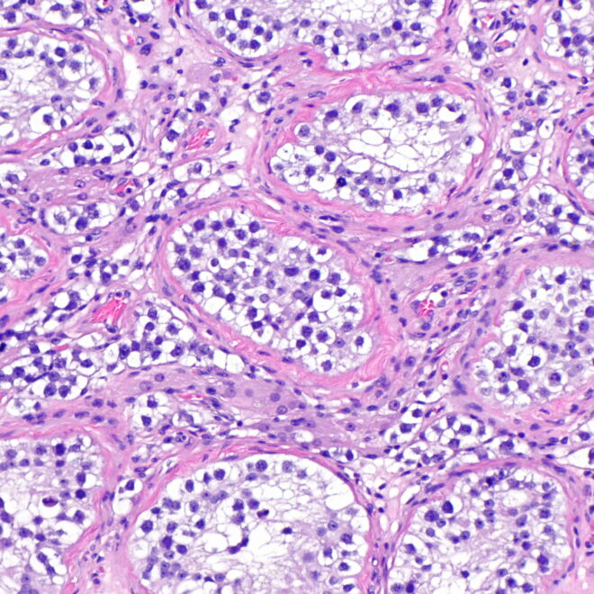 Testicular Cancer: Types, Causes, Symptoms, and Treatments