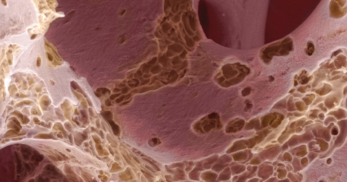 Osteoporosis: A Complete Guide to Understanding Bone Loss