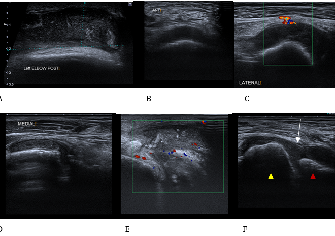 Elbow Bursitis (Olecranon Bursitis): Causes, Symptoms, and Treatments