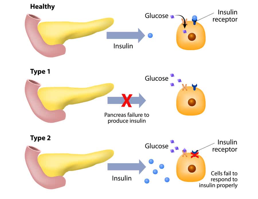 Gestational Diabetes: Causes, Symptoms, and Management During Pregnancy