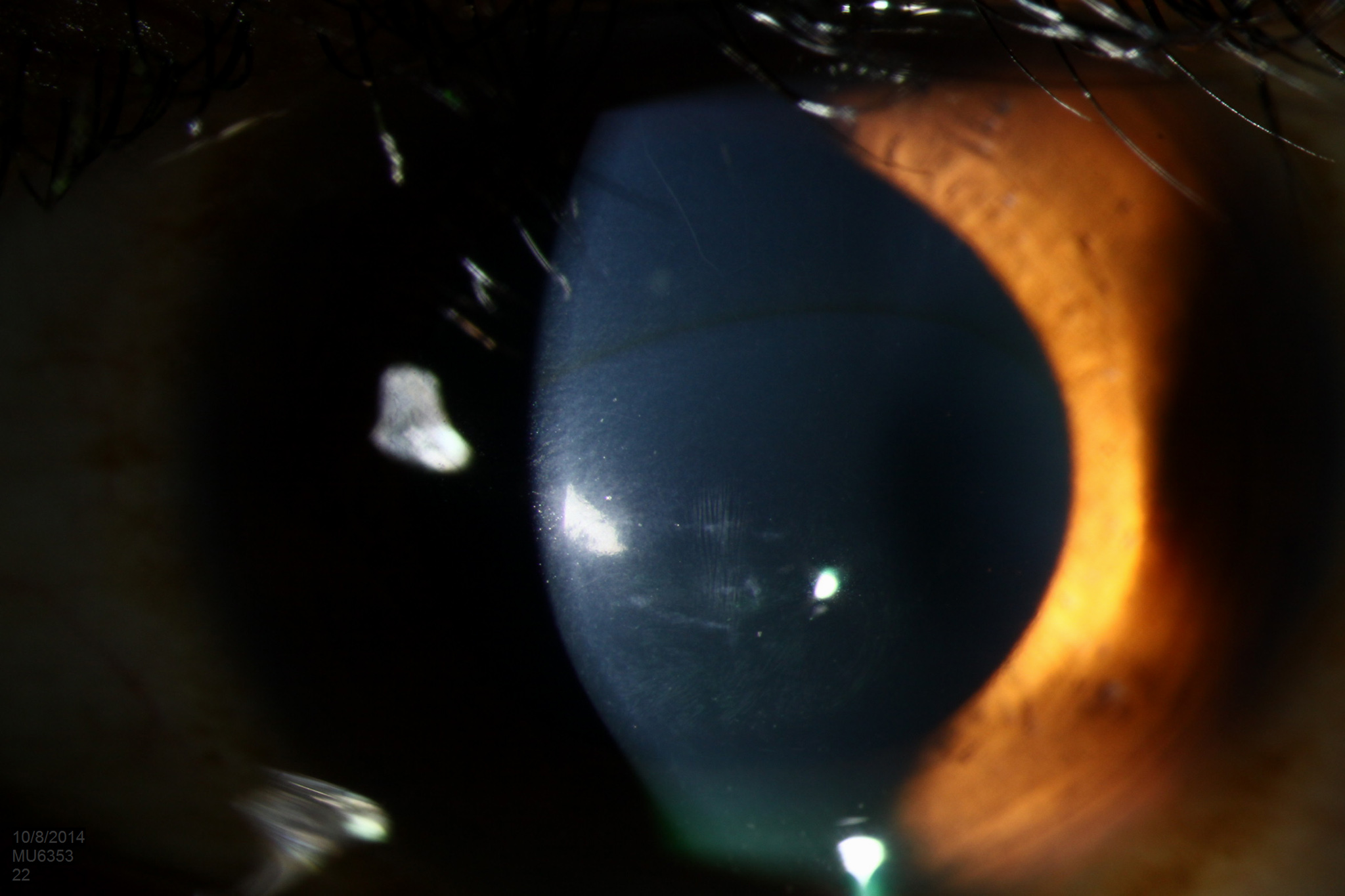 Keratoconus: Understanding the Eye Disorder That Affects Vision