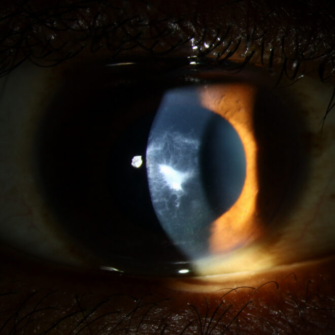 Keratoconus: Understanding the Eye Disorder That Affects Vision