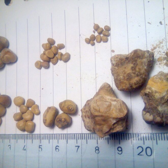 Kidney Stones: Causes, Types, Symptoms, and Treatments