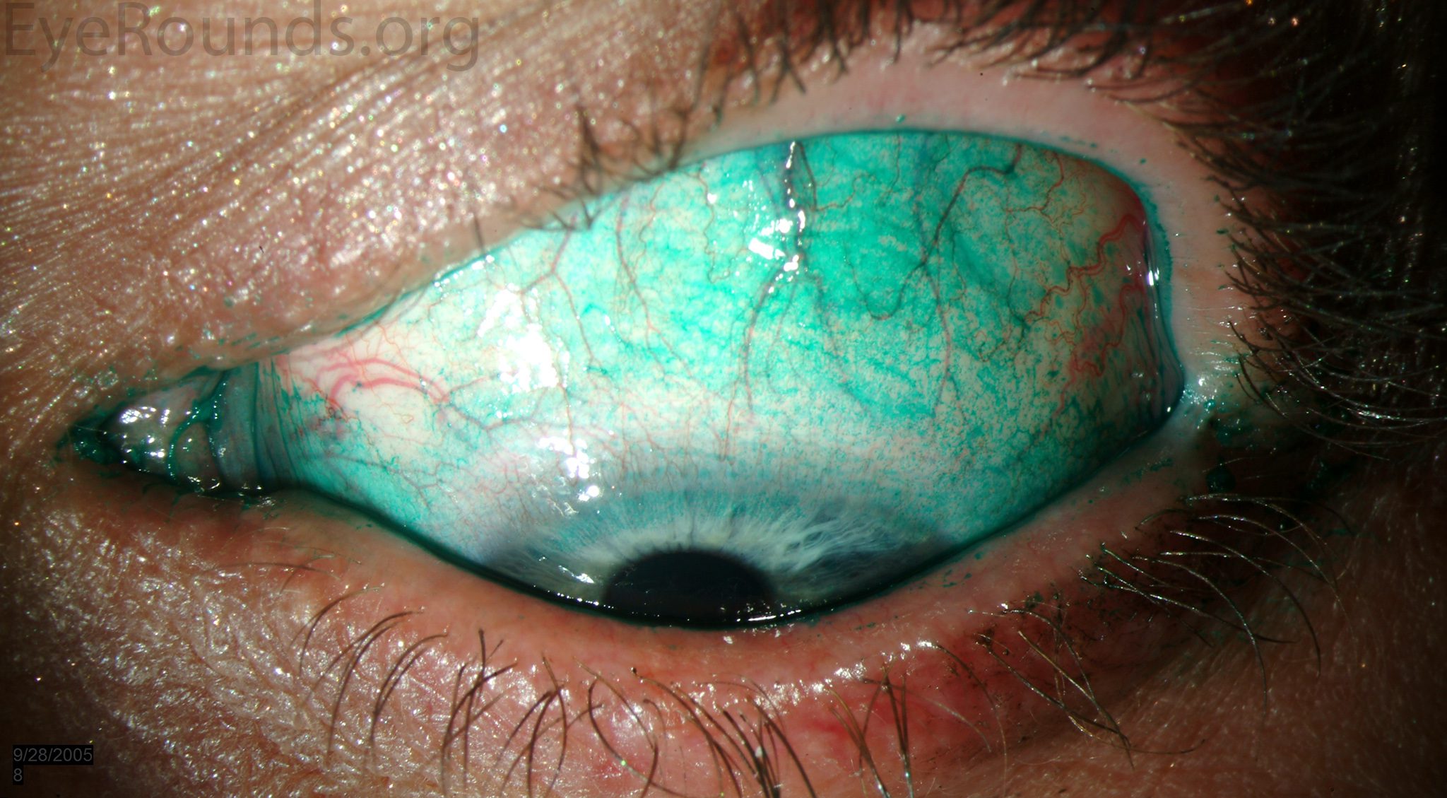 Dry Eye Syndrome (Keratoconjunctivitis Sicca): Causes, Symptoms, and Treatments