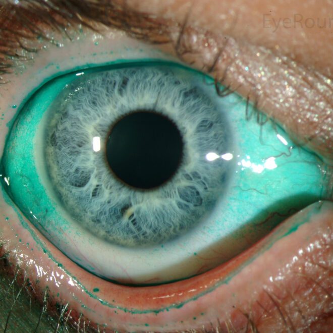 Dry Eye Syndrome (Keratoconjunctivitis Sicca): Causes, Symptoms, and Treatments