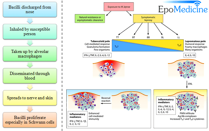 Leprosy (Hansen's Disease): Causes, Symptoms, Diagnosis, and Treatment