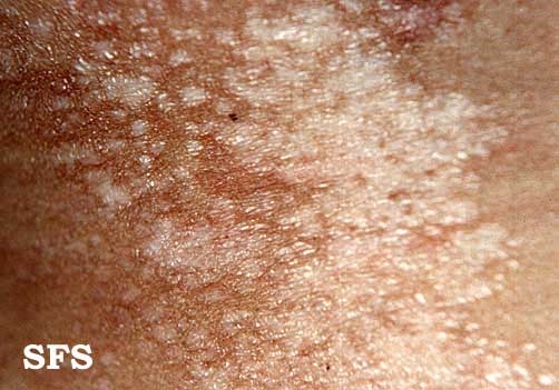 Lichen Sclerosus: Understanding the Skin Disorder (Chronic Inflammatory Dermatosis)