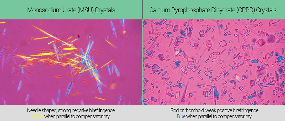 Pseudogout: Causes, Symptoms, Diagnosis, and Treatment (Calcium Pyrophosphate Deposition Disease)