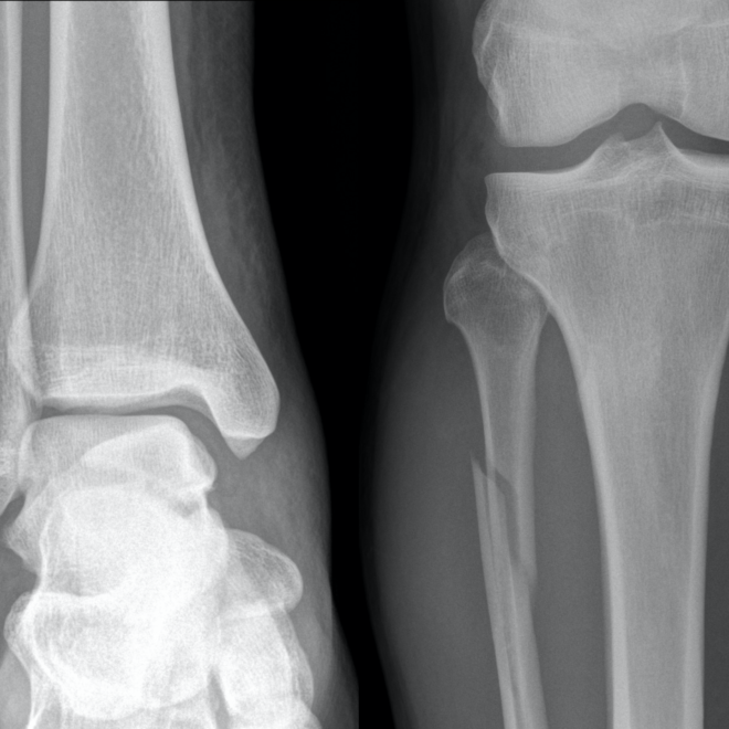 Nasal Fracture (Broken Nose): Causes, Symptoms, and Treatment Options