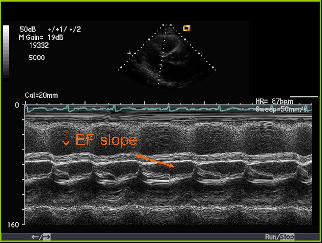 Mitral Valve Regurgitation: Causes, Symptoms, Diagnosis, and Treatment