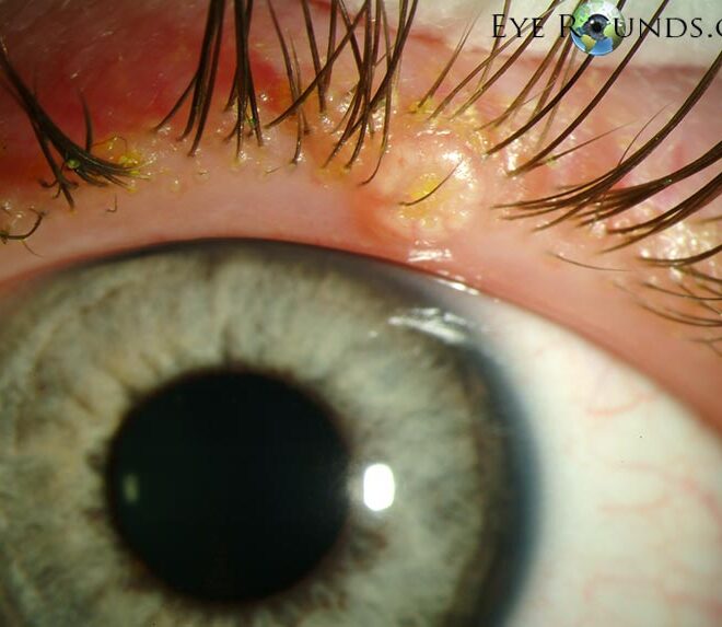 Molluscum Contagiosum: Overview, Causes, Symptoms & Treatments