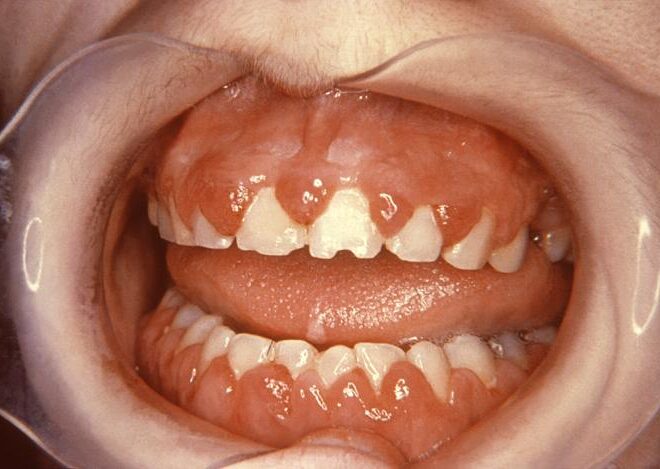 Oral Thrush (Oral Candidiasis): Causes, Symptoms, and Treatments