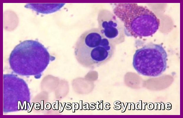 Myelodysplastic Syndromes (MDS): Overview, Types, Causes, and Treatments
