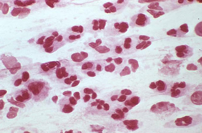 Urethritis: Causes, Symptoms, Diagnosis, and Treatment Options