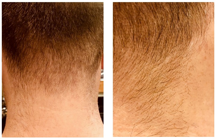 Ingrown Hair: Causes, Symptoms, and How to Treat It