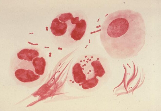 Gonorrhea: Causes, Symptoms, Diagnosis, and Treatment (Sexually Transmitted Infection)