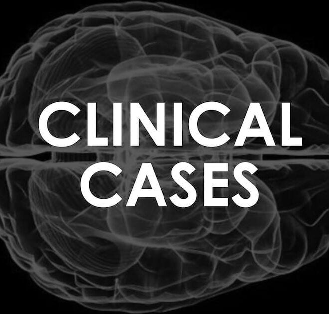 Pseudobulbar Affect (PBA): Symptoms, Causes & Management