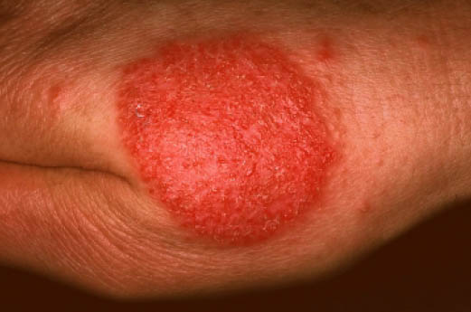 Nummular Dermatitis: Overview, Causes, Symptoms & Treatments