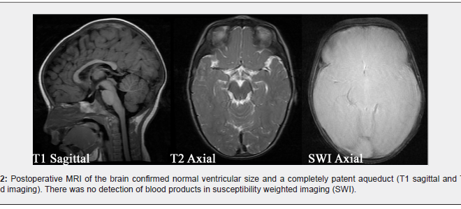 Hydrocephalus: Causes, Symptoms, and Treatments