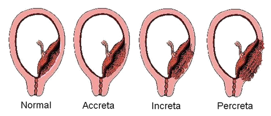Placenta Previa: Causes, Symptoms, Diagnosis, and Treatment