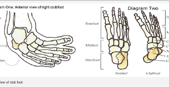 Clubfoot: Understanding the Deformity, Its Causes, Diagnosis, and Treatment Options