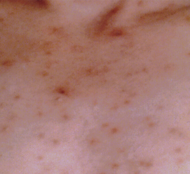 Chickenpox (Varicella): Causes, Symptoms, and Treatments