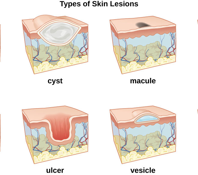 Boils: Causes, Symptoms, Treatment, and Prevention