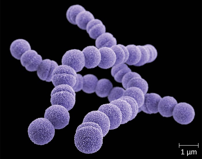 Strep Throat (Streptococcal Pharyngitis): Causes, Symptoms, Diagnosis & Care