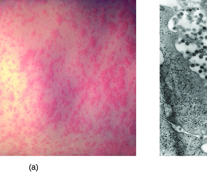 Measles (Rubeola): Symptoms, Causes, Transmission, and Prevention