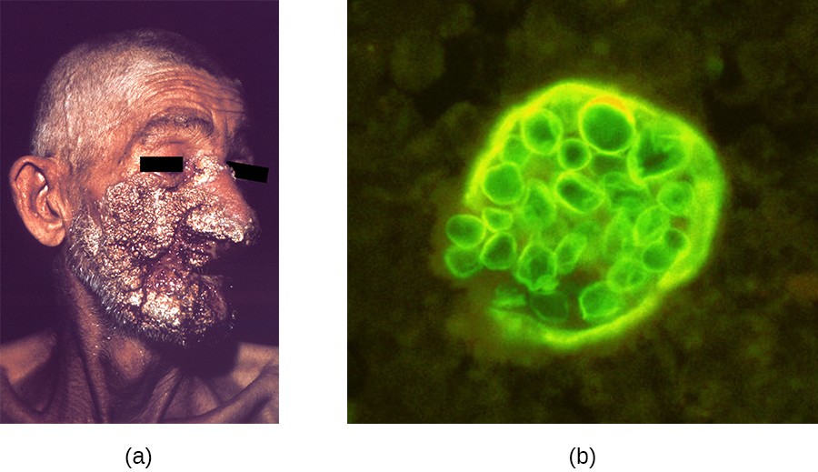 Valley Fever (Coccidioidomycosis): Causes, Symptoms, Diagnosis & Treatment