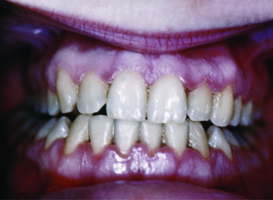 Gingivitis: Causes, Symptoms, Prevention, and Treatment