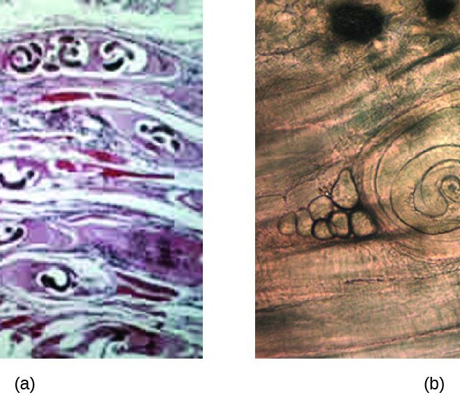 Trichinosis: Causes, Symptoms, Diagnosis, and Treatment (Roundworm Infection)