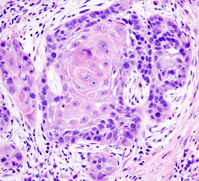 Tongue Cancer: Understanding Causes, Symptoms, and Treatments