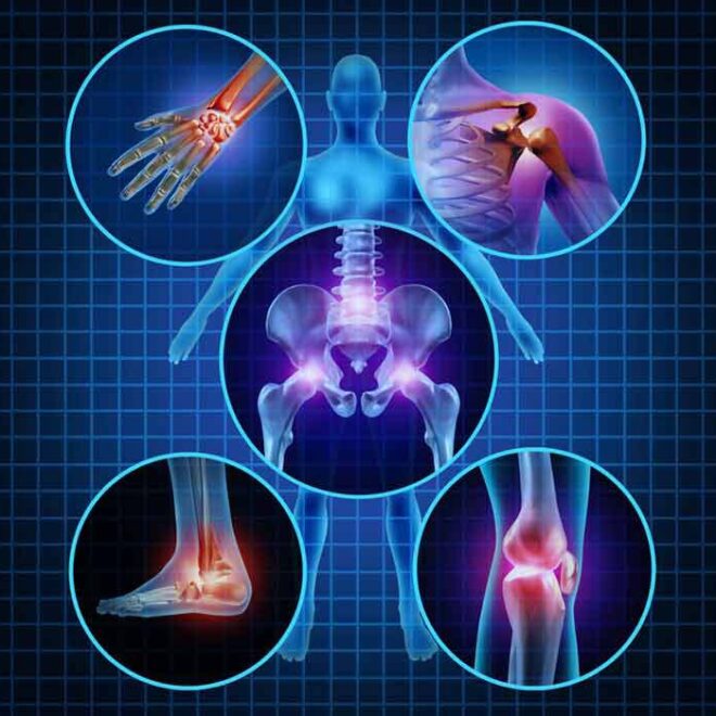 Osteoarthritis: Causes, Symptoms, Diagnosis, and Treatment Options