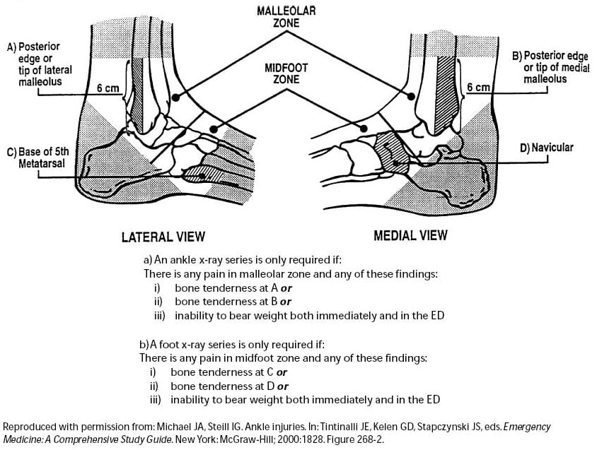 Ankle Sprain: Types, Causes, Symptoms, and Recovery Steps