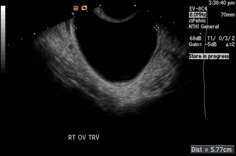 Ovarian Cysts: Types, Causes, Diagnosis, and Treatments