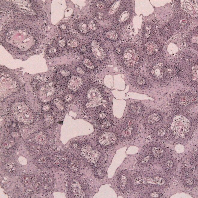 Craniopharyngioma: Understanding the Brain Tumor Near the Pituitary Gland