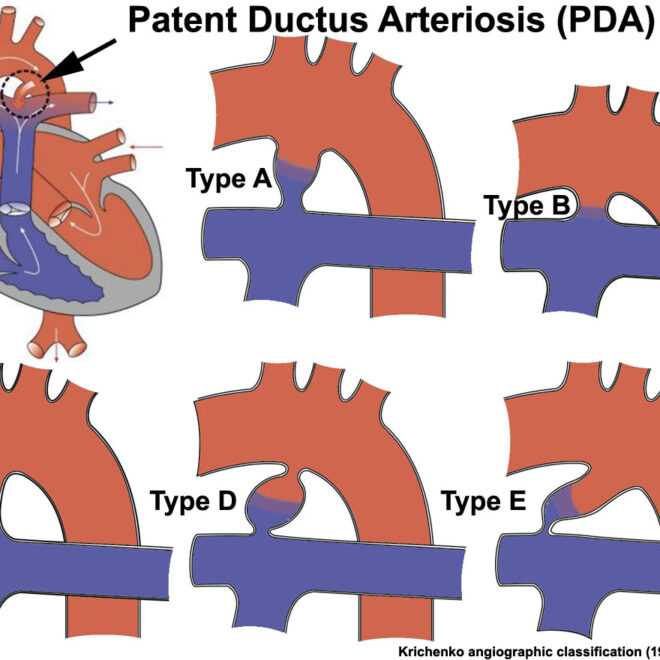 Patent Ductus Arteriosus (PDA): Overview, Causes, Symptoms & Treatment
