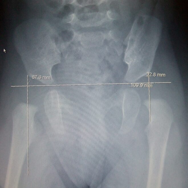 Hip Dysplasia: A Complete Guide to Understanding the Condition (Developmental Hip Disorder)