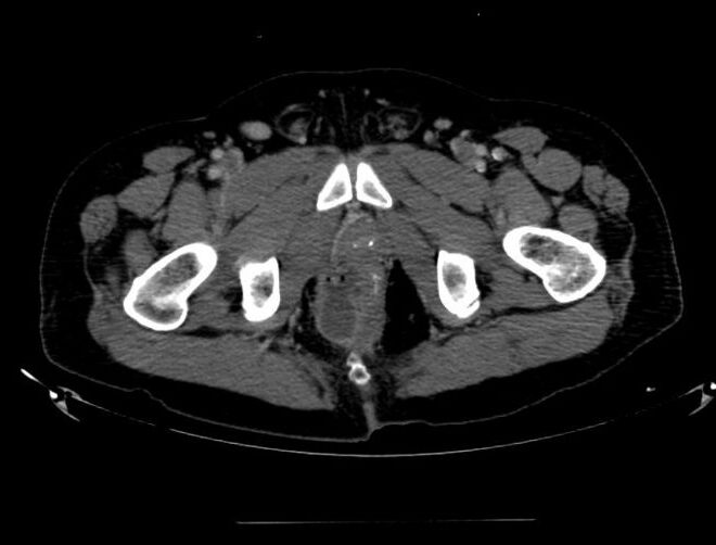 Perirectal Abscess: Causes, Symptoms, Diagnosis, and Treatment
