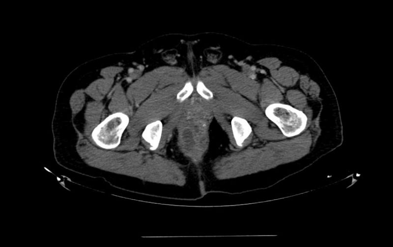 Perirectal Abscess: Causes, Symptoms, Diagnosis, and Treatment