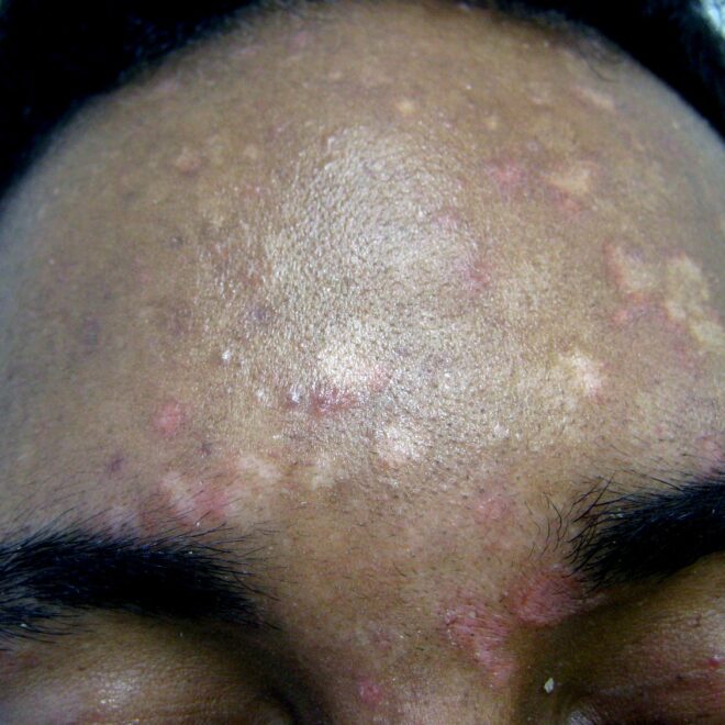 Tinea Versicolor (Fungal Skin Infection): Overview, Causes, Symptoms & Treatments